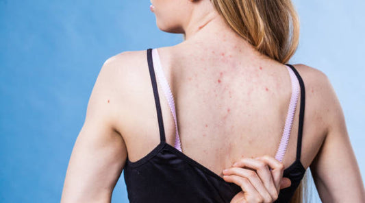 Beyond the Face: Treating Acne on Your Back, Chest, and Shoulders