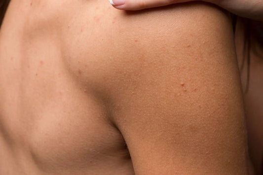 Beyond the Face: Treating Acne on Your Back, Chest, and Shoulders - Skin Choice