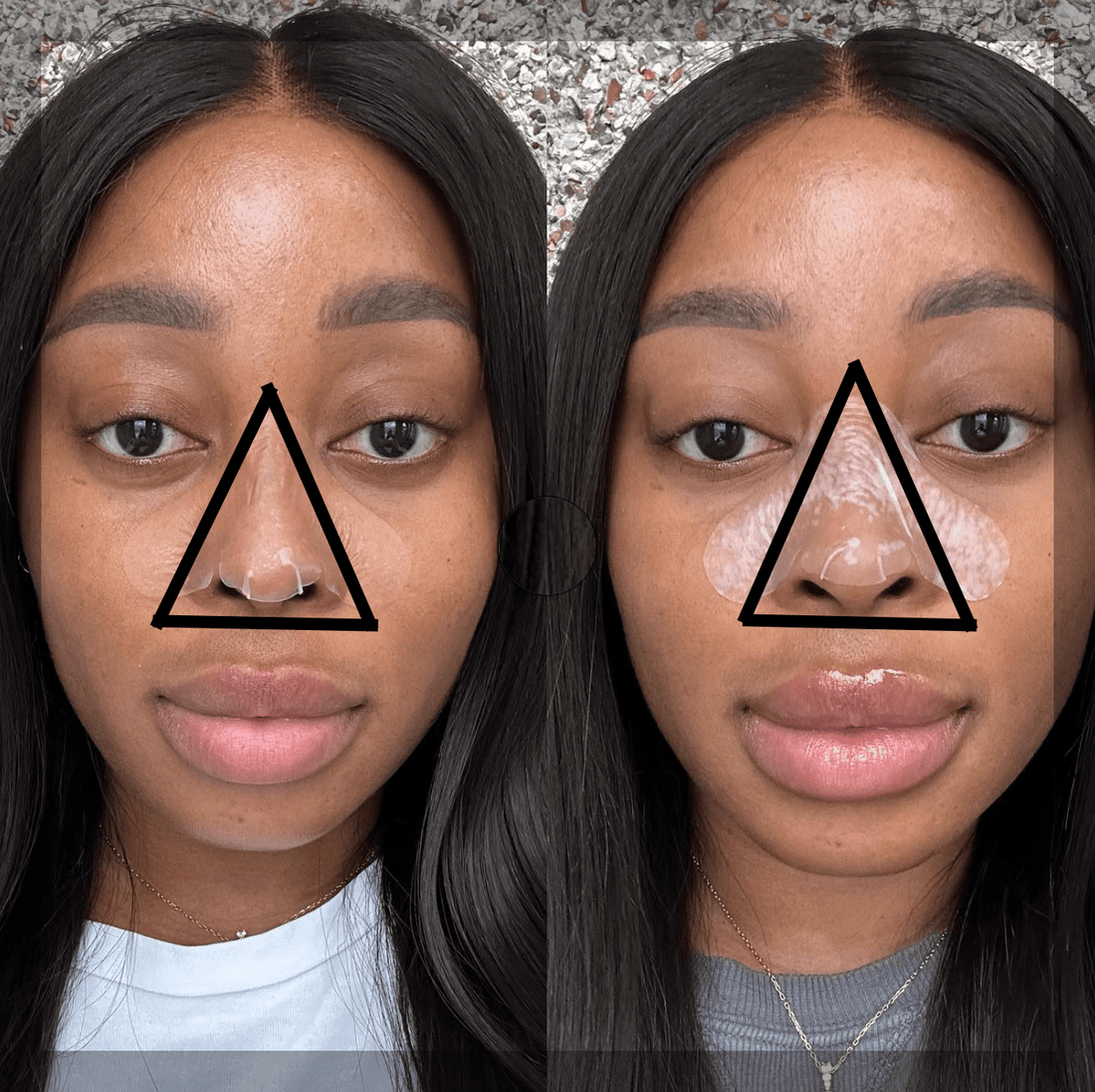 The Danger Triangle of the Face and the Why Using Hydrocolloid Strips for Pimple Treatment is Better - Skin Choice