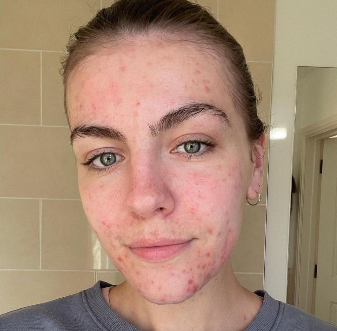 The Science Behind Clear Skin: Understanding Acne Causes and Solutions - Skin Choice