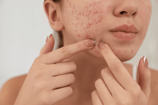 What to Do If You Accidentally Pop a Pimple and It Bleeds: A Quick Fix Guide - Skin Choice