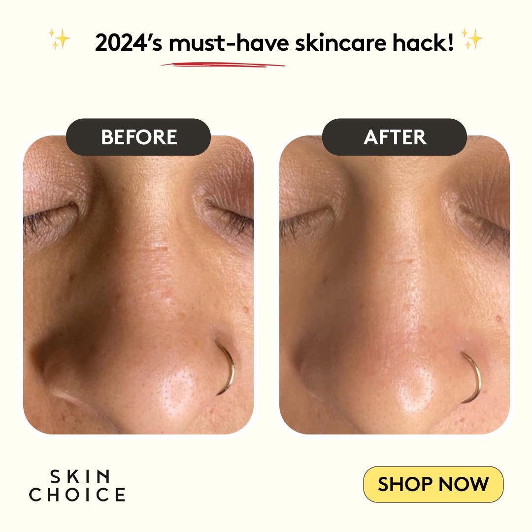 Nose Pore Patches - Skin Choice