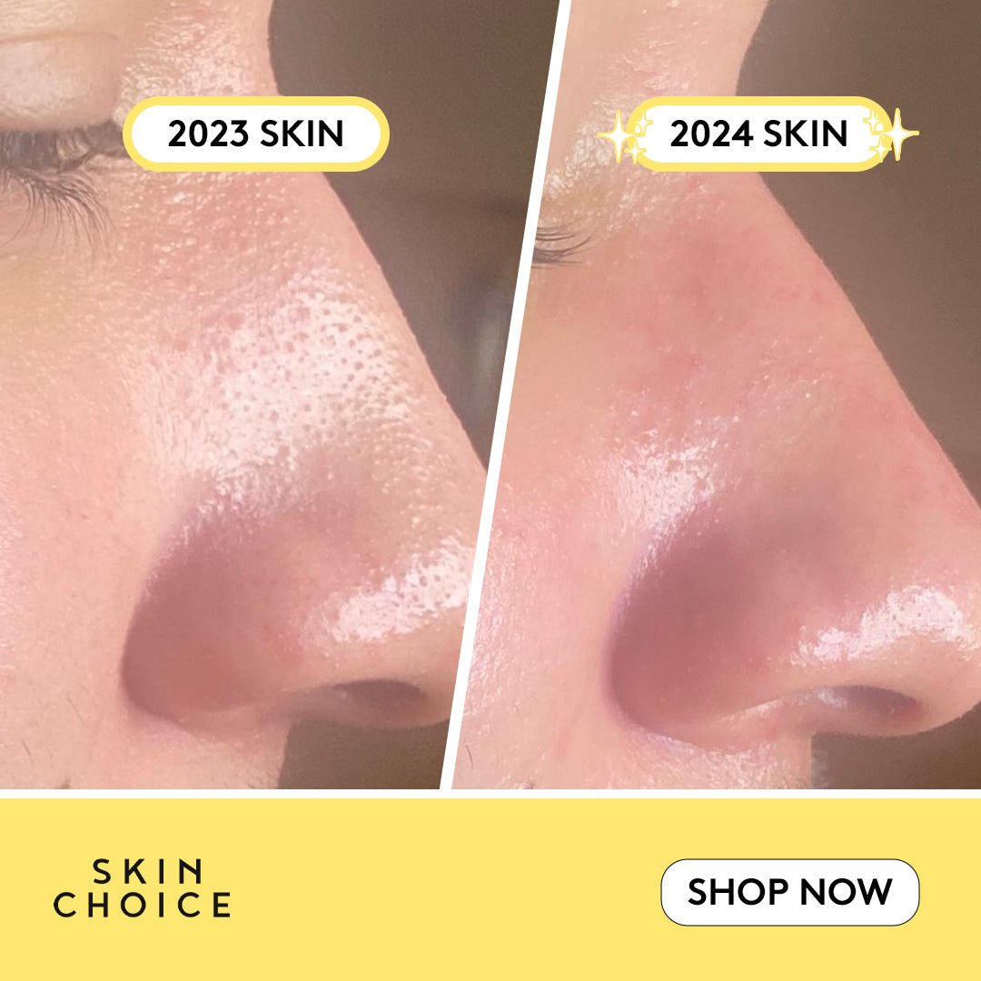 Nose Pore Patches - Skin Choice